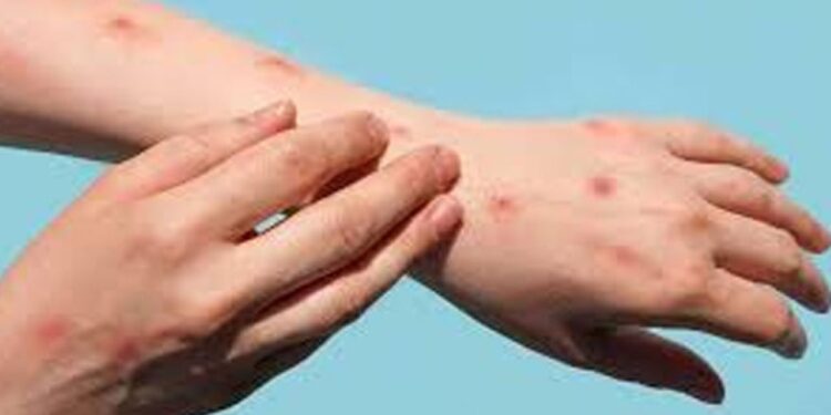KP reports 8th Mpox case of 2025